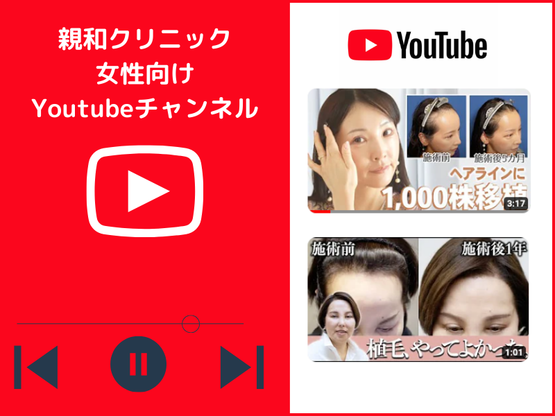 女性の自毛植毛を動画でご紹介