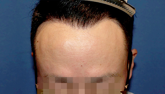 40代 男性  K.S.さん 生え際 自毛植毛（MIRAI法）1,500株の症例｜自毛植毛の症例（手術後）