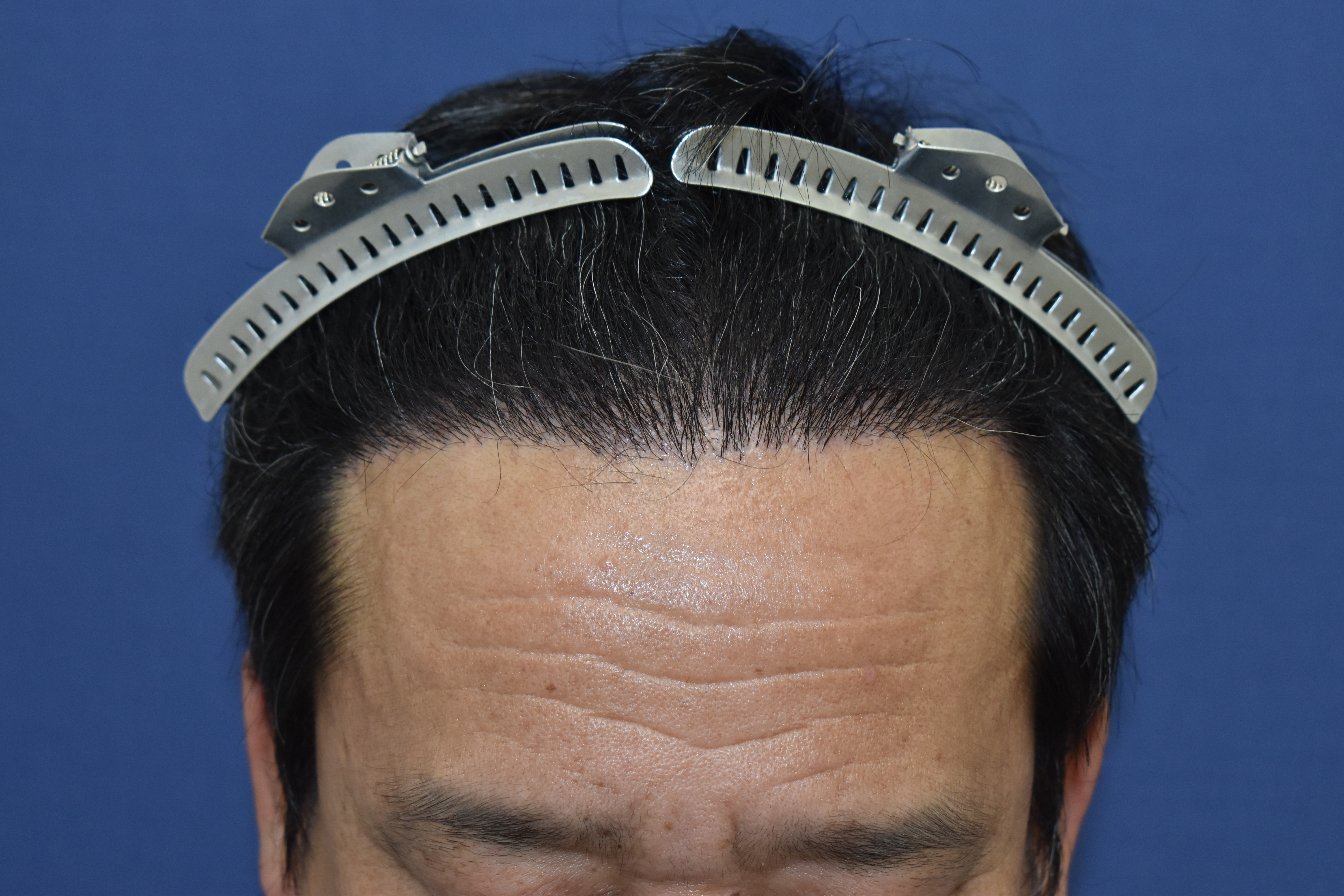 40代 男性 I.S.さん 生え際・前頭部・右こめかみ自毛植毛（MIRAI法）2,800株の症例｜自毛植毛の症例（手術後）