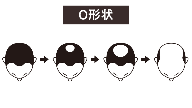 頭頂部が薄くなるO形状