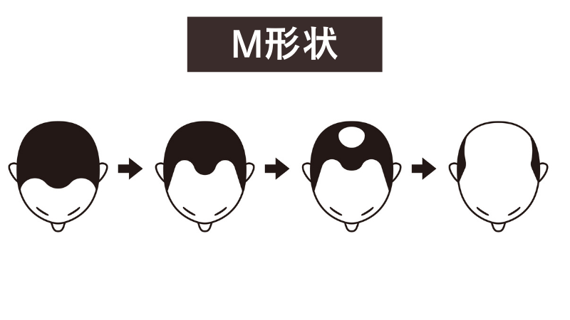 前頭部の額の生え際から進行するM形状