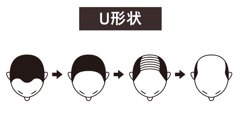 前頭部から全体的に進行するU形状
