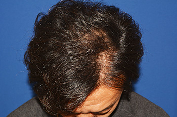 40代 男性 I.M.さん 生え際・頭頂部 自毛植毛（MIRAI法）1,500株の症例｜自毛植毛の症例（術後1年）
