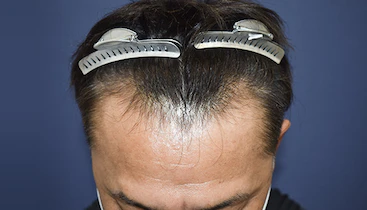 50代男性 施術前