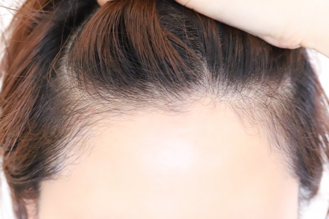 人気のヘアライン植毛とは？