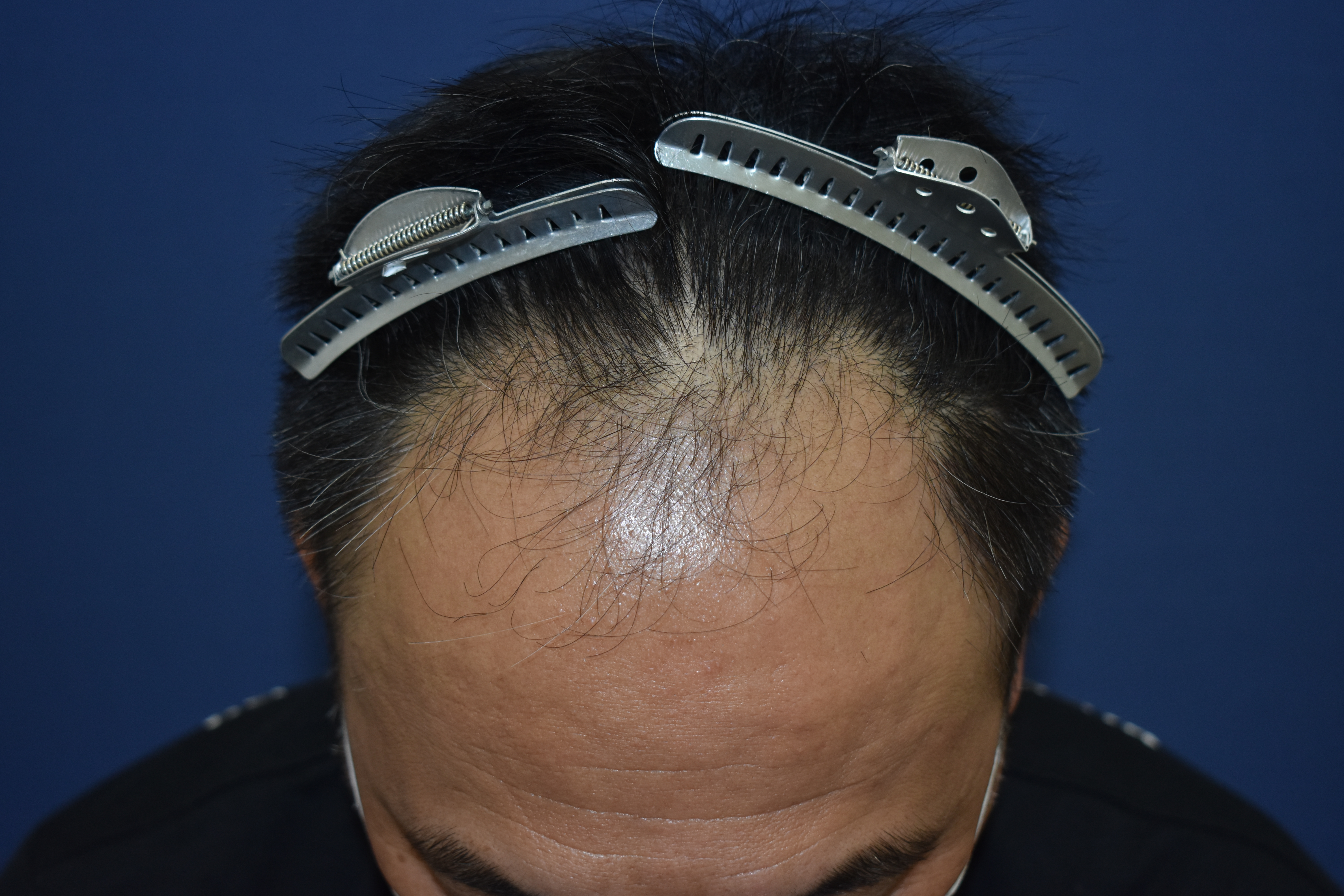 40代 男性 S.A.さん 生え際 自毛植毛（MIRAI法）2,200株の症例｜自毛植毛の症例（手術前）