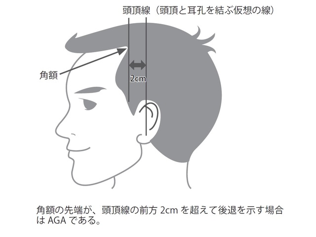 AGA診断