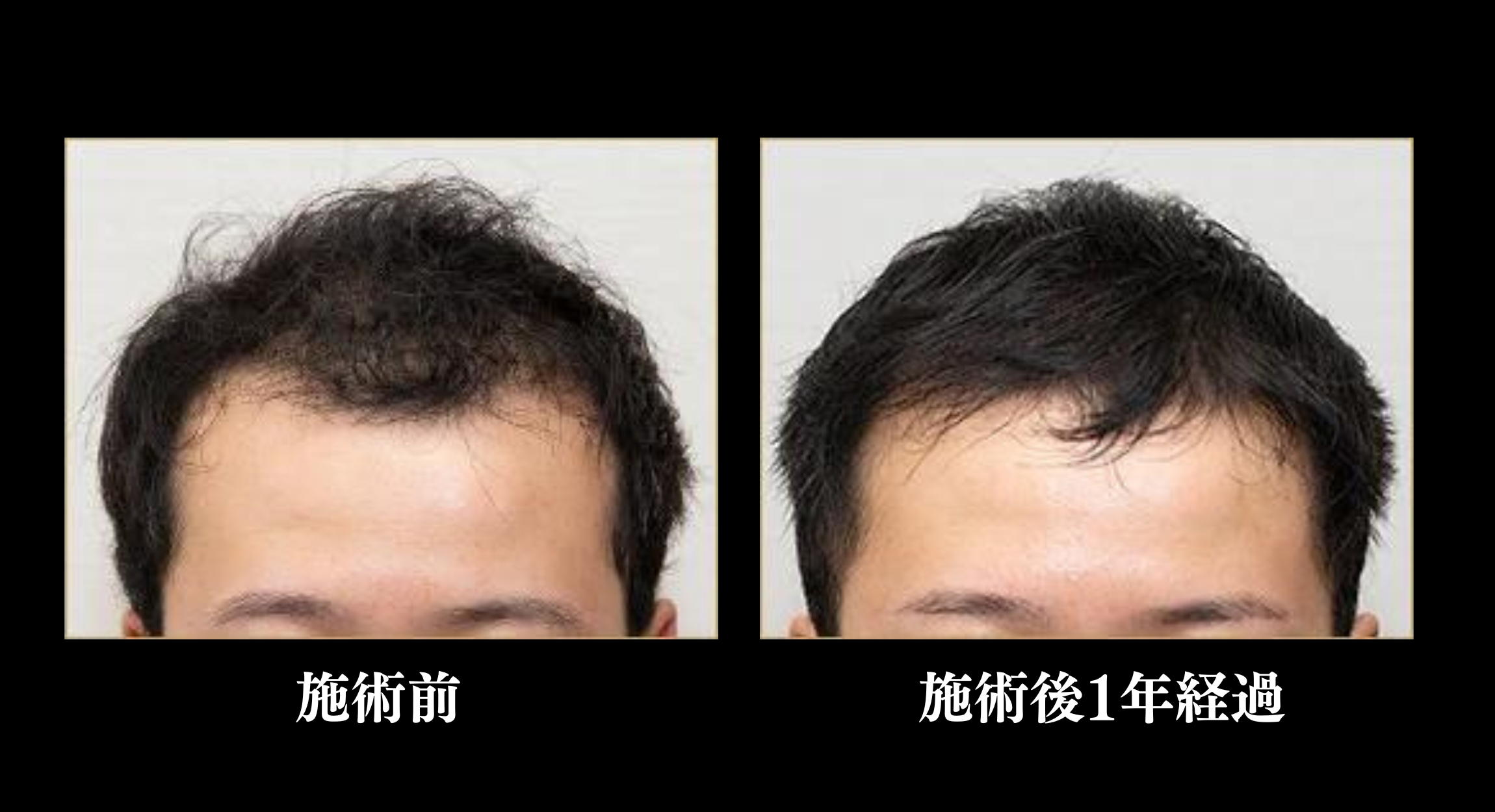 施術前と施術後1年経過1