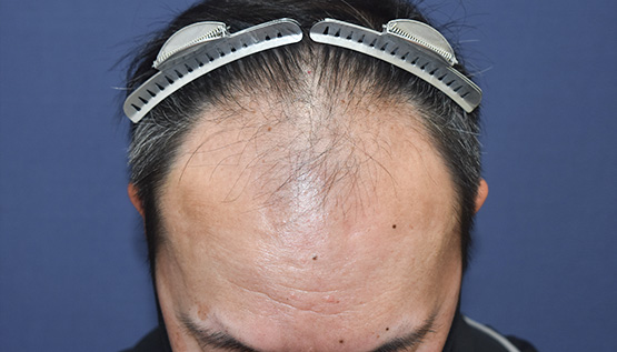 40代 男性 Y.K.さん 生え際・前頭部 自毛植毛（MIRAI法）3,000株の症例｜自毛植毛の症例（手術前）