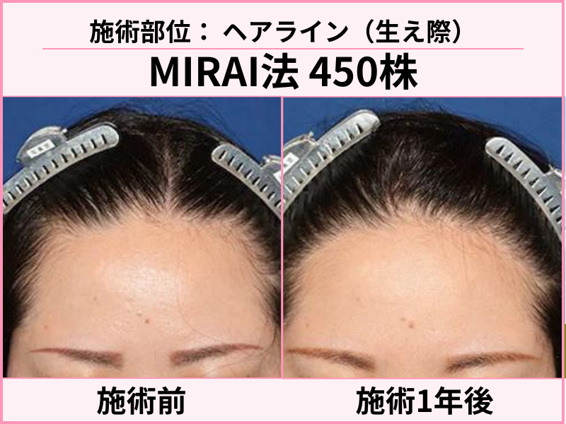 ヘアライン植毛の症例