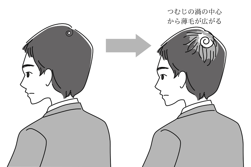 頭頂部（つむじ）の薄毛