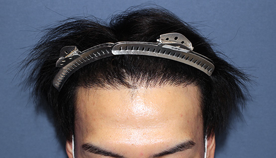 20代 男性  Y.B.さん 生え際・前頭部・頭頂部（MIRAI法）3,000株の症例｜自毛植毛の症例（手術前）