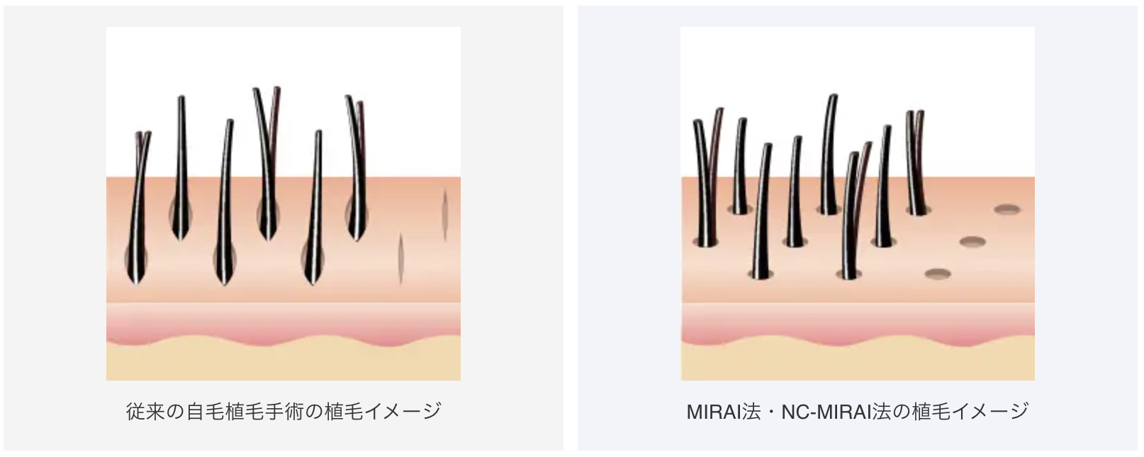 従来のFUE法とMIRAI法の違い