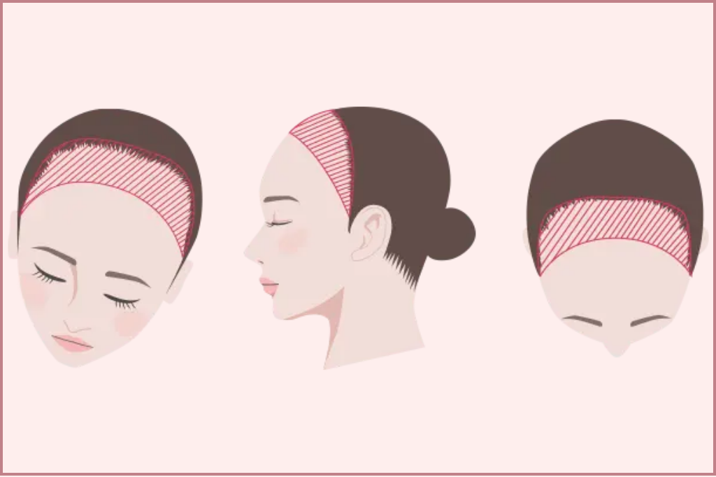 ヘアラインの修正にかかる費用