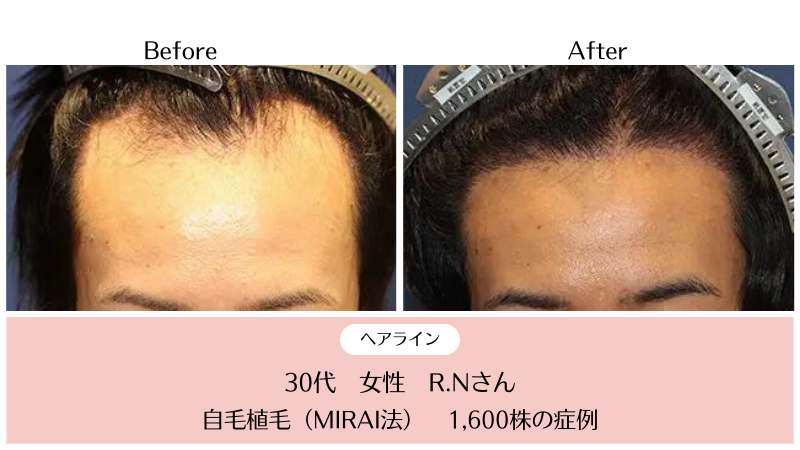 ヘアライン植毛（生え際）