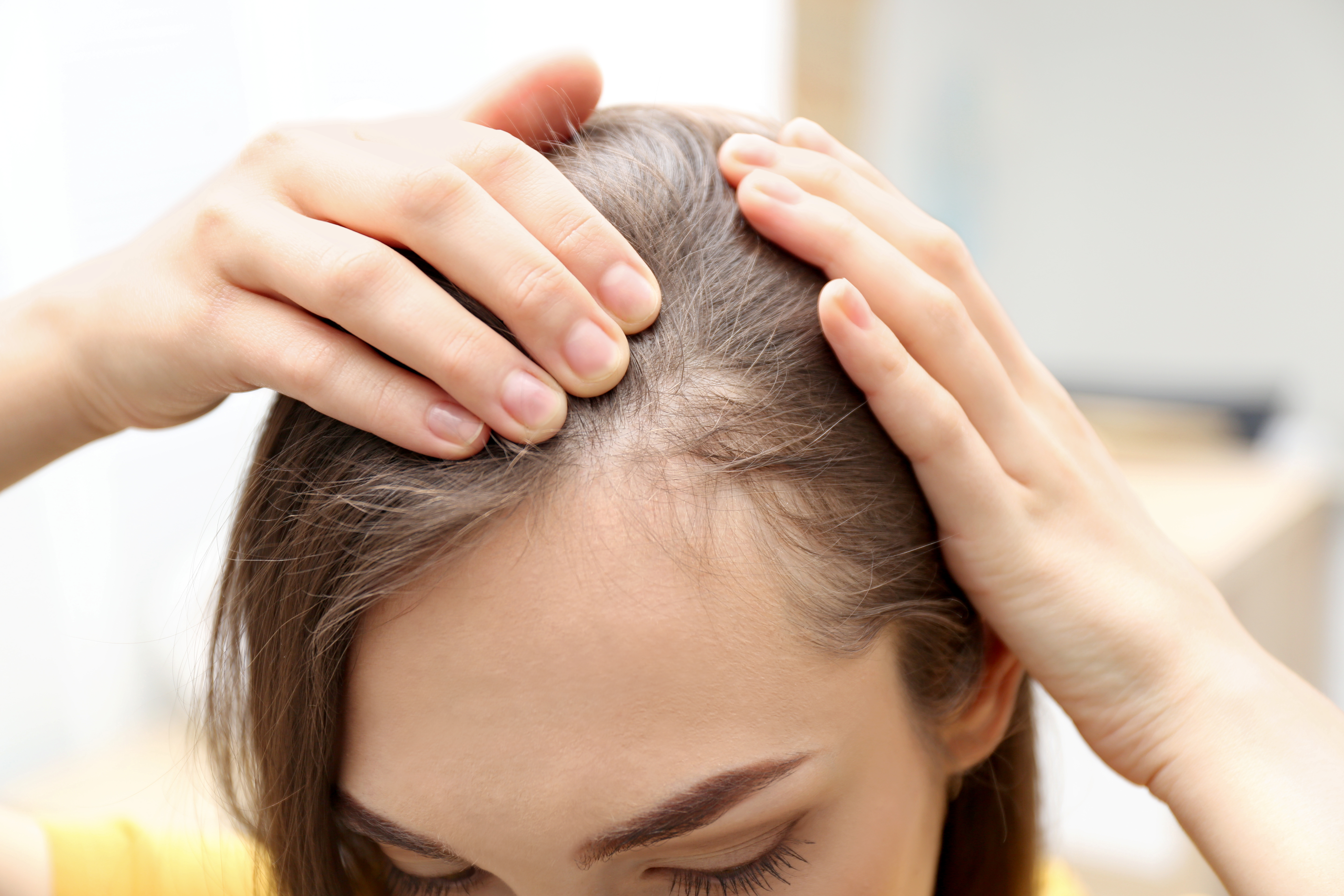 ヘアラインの植毛