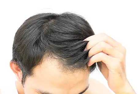 薄毛の悩みは植毛で解消できる？