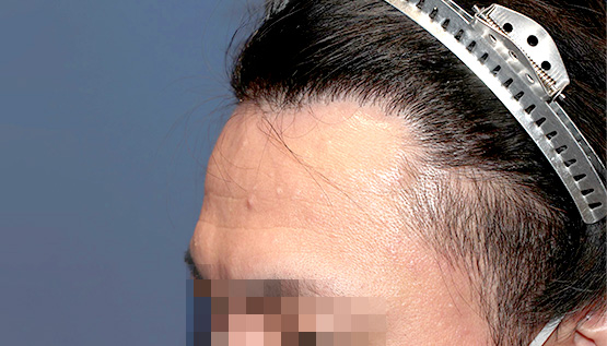 30代 男性 M.W.さん 生え際・瘢痕部 自毛植毛（MIRAI法）1,200株の症例｜自毛植毛の症例（手術後）