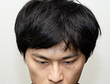 30代男性S.M.さんの正面写真（施術後）