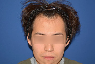 20代 男性 S.T.さん 生え際 自毛植毛（MIRAI法） 2,000株の症例｜自毛植毛の症例（手術前）