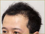 20代男性M.Y.さんを左から見た写真（施術前）