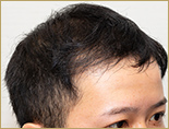 20代男性M.Y.さんを右から見た写真（施術後）