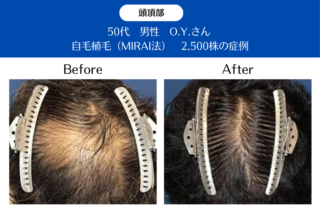 50代 男性 O.Y.さん／頭頂部の自毛植毛(MIRAI法)／2,500株の症例