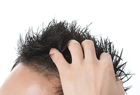日本人男性の3割が悩む「AGA」とは？