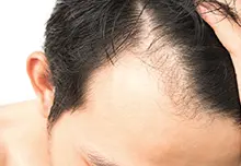 広範囲の薄毛を改善できる