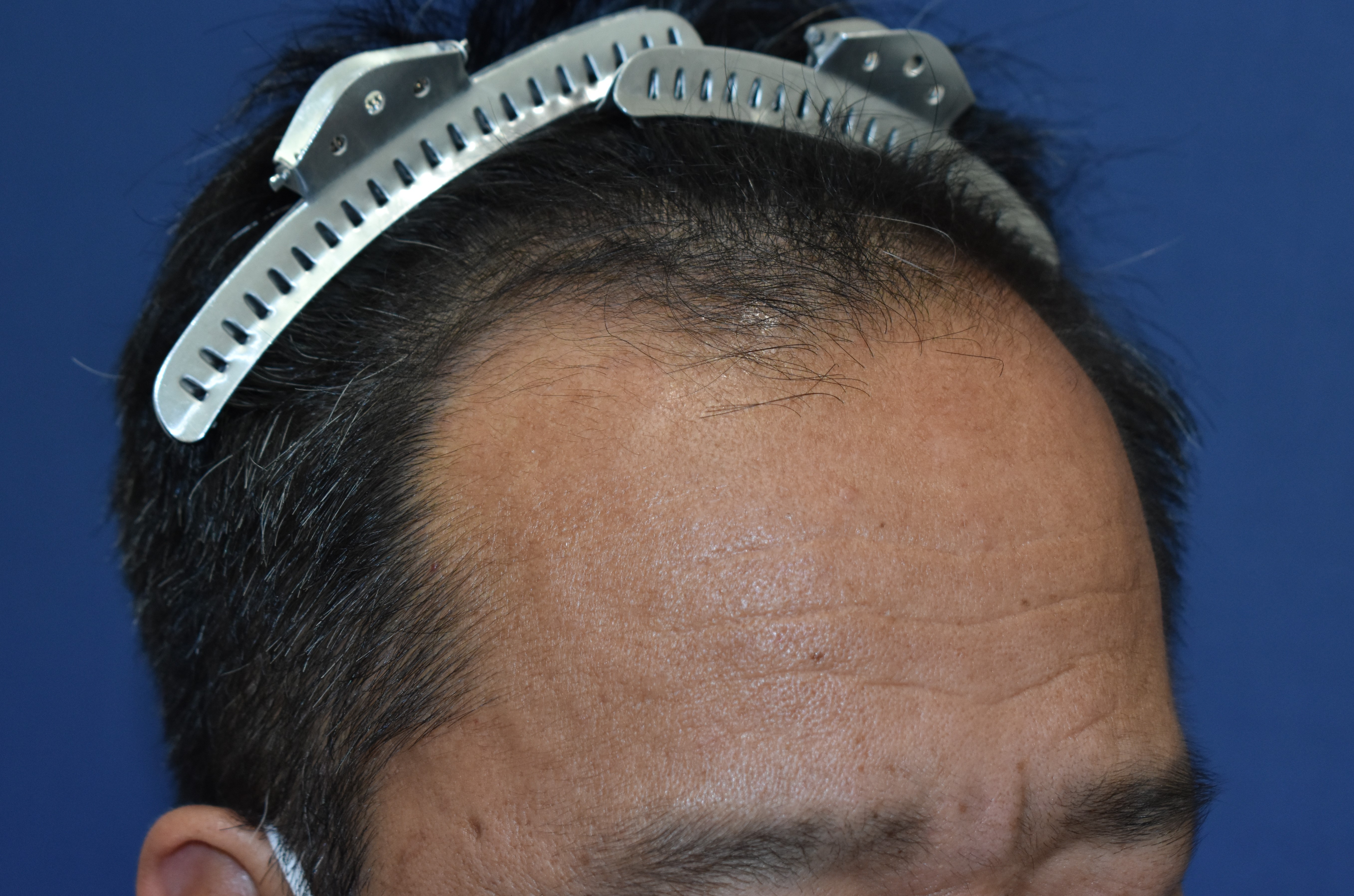 手術前の状態（右側）