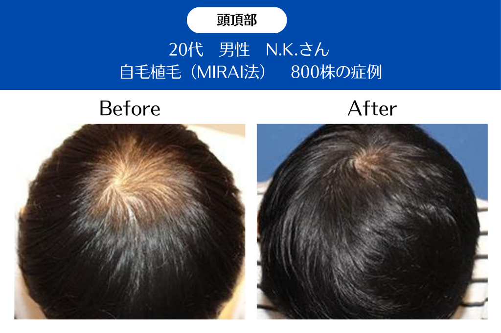 20代 男性 N.K.さん／頭頂部の自毛植毛(MIRAI法)／800株の症例