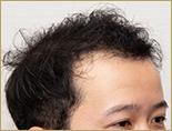 20代男性M.Y.さんを右から見た写真（施術前）