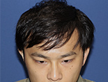 30代男性S.M.さんの正面写真（施術前）