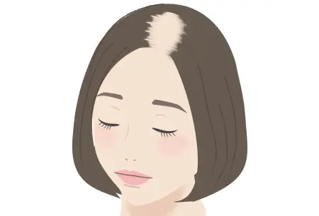 女性に最も多い”びまん性脱毛”とは？